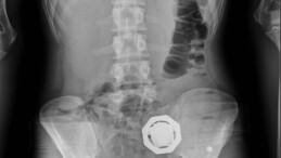 4 şüphelinin midesinden 121 parça halinde 840 gram eroin çıktı