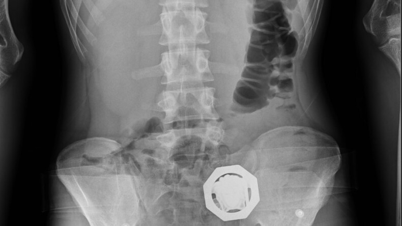 4 şüphelinin midesinden 121 parça halinde 840 gram eroin çıktı